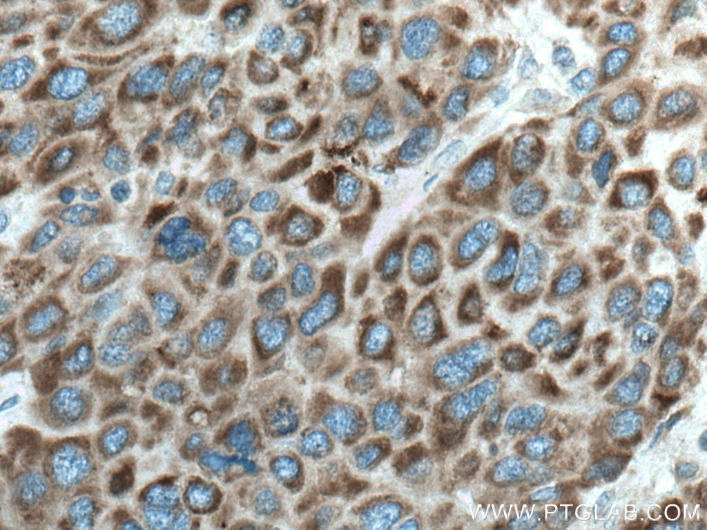 IHC staining of human liver cancer using 67045-1-Ig