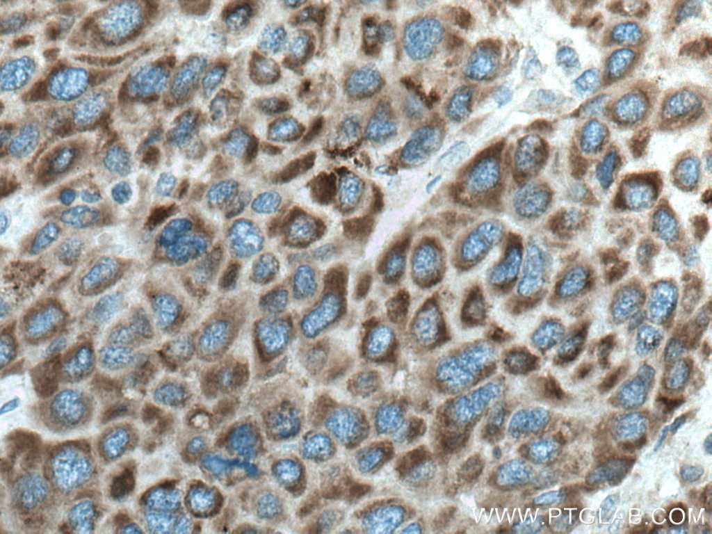 Immunohistochemistry (IHC) staining of human liver cancer tissue using CYP27A1 Monoclonal antibody (67045-1-Ig)