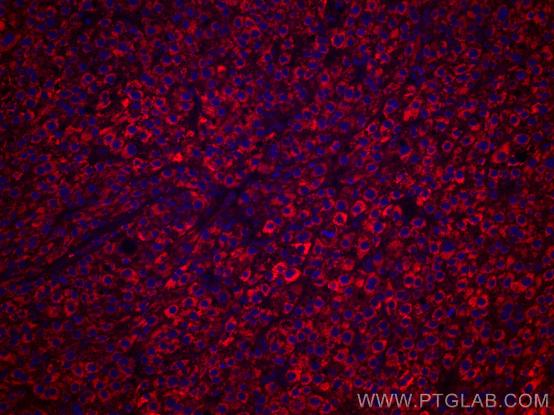 IF Staining of human liver cancer using CL594-67045