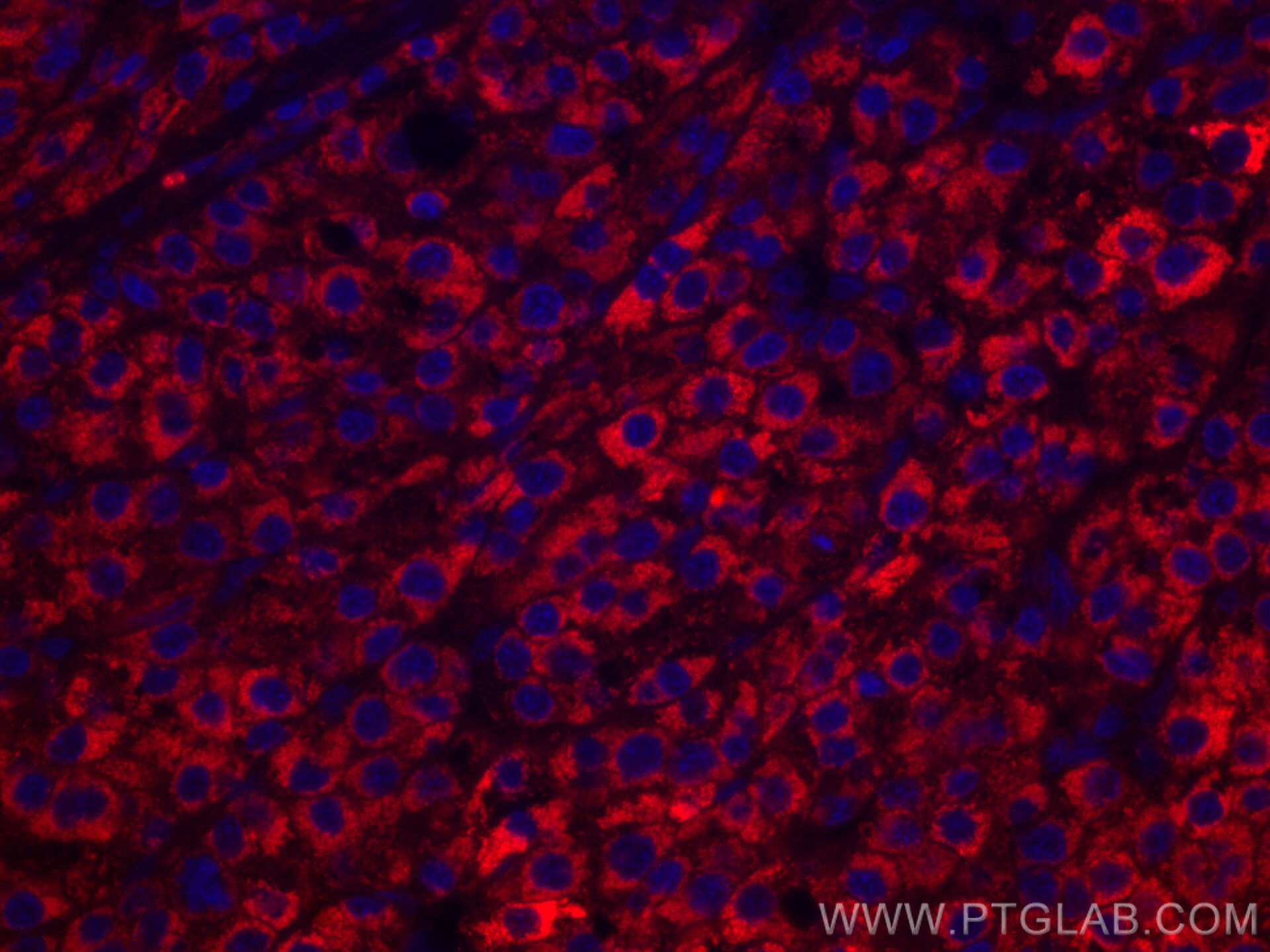 Immunofluorescence (IF) / fluorescent staining of human liver cancer tissue using CoraLite®594-conjugated CYP27A1 Monoclonal antibod (CL594-67045)