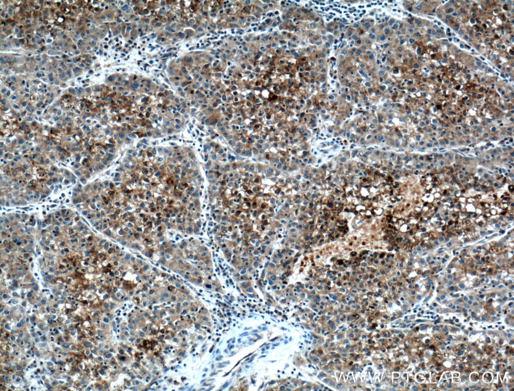 Immunohistochemistry (IHC) staining of human liver cancer tissue using CYP2A6 Polyclonal antibody (21721-1-AP)