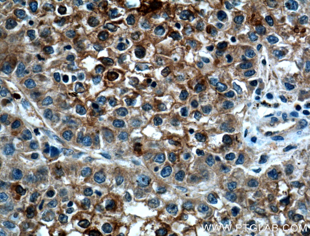 Immunohistochemistry (IHC) staining of human liver cancer tissue using CYP2A6 Polyclonal antibody (21721-1-AP)
