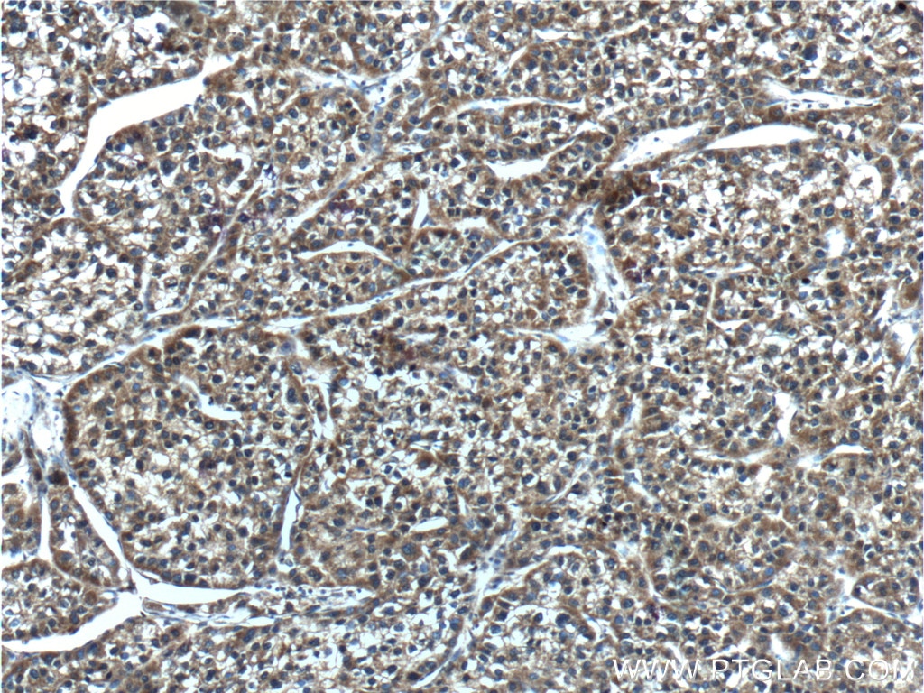 Immunohistochemistry (IHC) staining of human liver cancer tissue using CYP2C19 Polyclonal antibody (55453-1-AP)