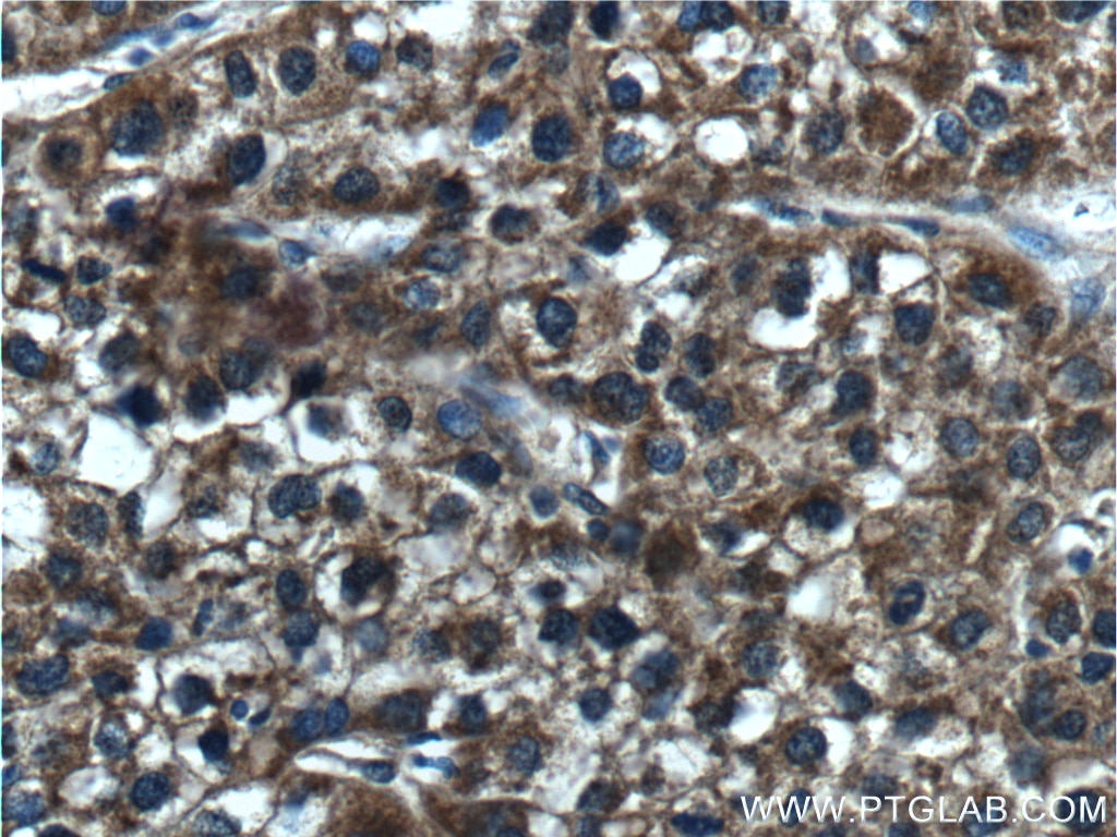 Immunohistochemistry (IHC) staining of human liver cancer tissue using CYP2C19 Polyclonal antibody (55453-1-AP)