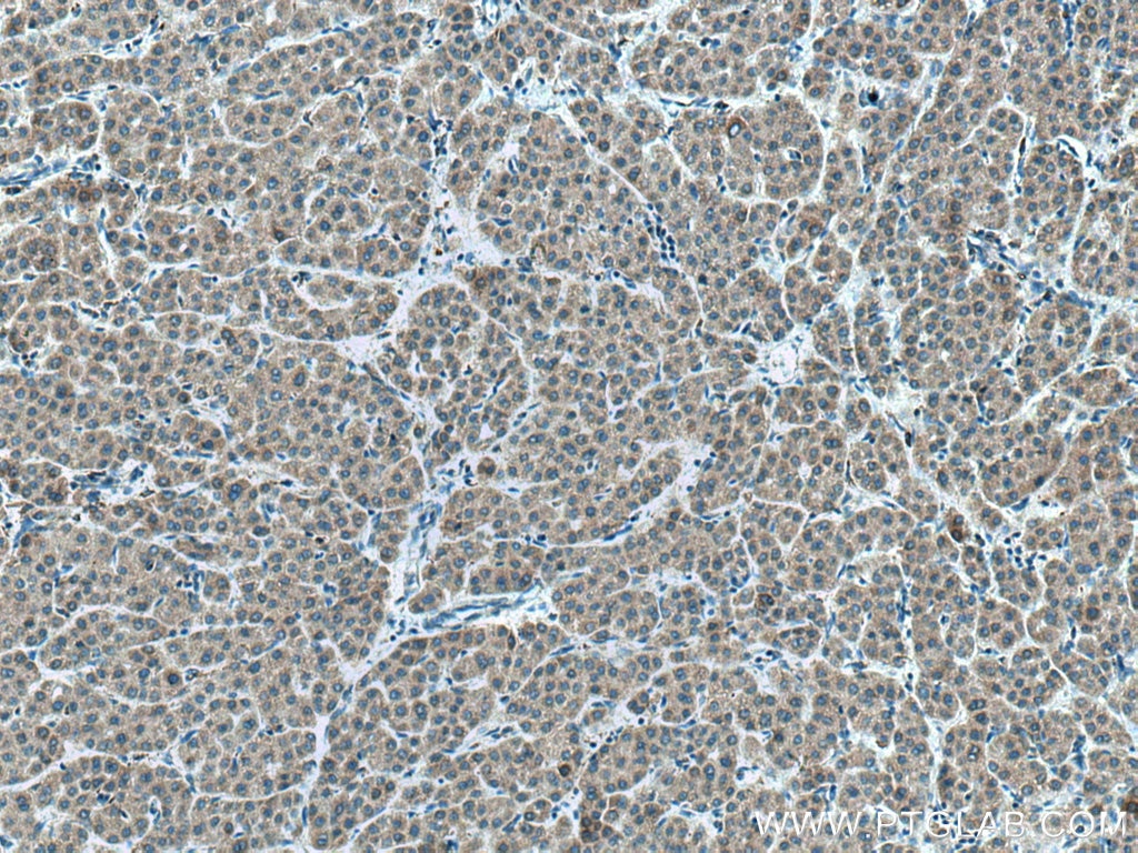 Immunohistochemistry (IHC) staining of human liver cancer tissue using CYP2C8/9/18/19 Polyclonal antibody (16546-1-AP)