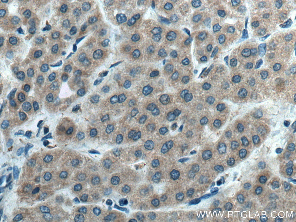Immunohistochemistry (IHC) staining of human liver cancer tissue using CYP2C8/9/18/19 Polyclonal antibody (16546-1-AP)