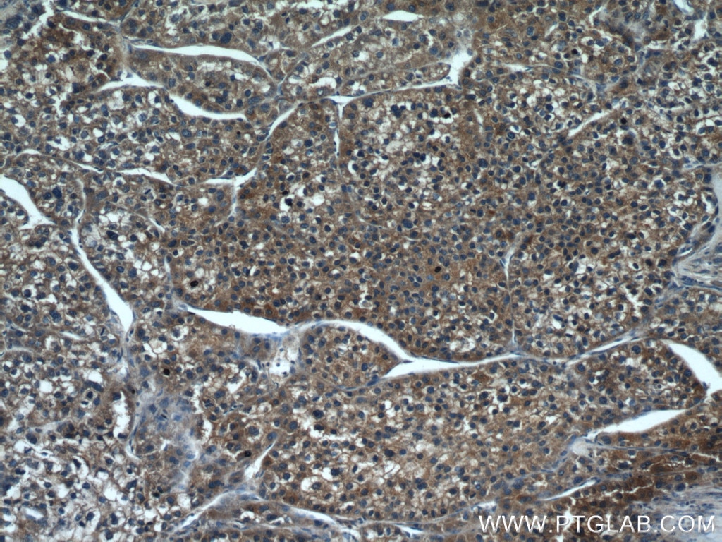 Immunohistochemistry (IHC) staining of human liver cancer tissue using CYP2D6/7 Polyclonal antibody (17868-1-AP)