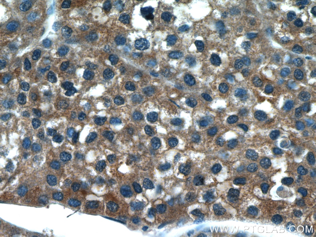 IHC staining of human liver cancer using 17868-1-AP