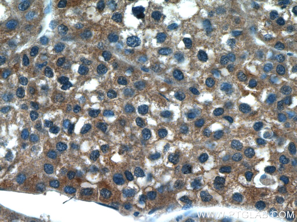 Immunohistochemistry (IHC) staining of human liver cancer tissue using CYP2D6/7 Polyclonal antibody (17868-1-AP)