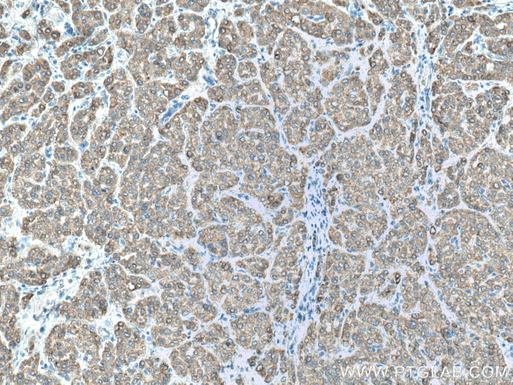 Immunohistochemistry (IHC) staining of human liver cancer tissue using CYP2D6/7 Polyclonal antibody (17868-1-AP)