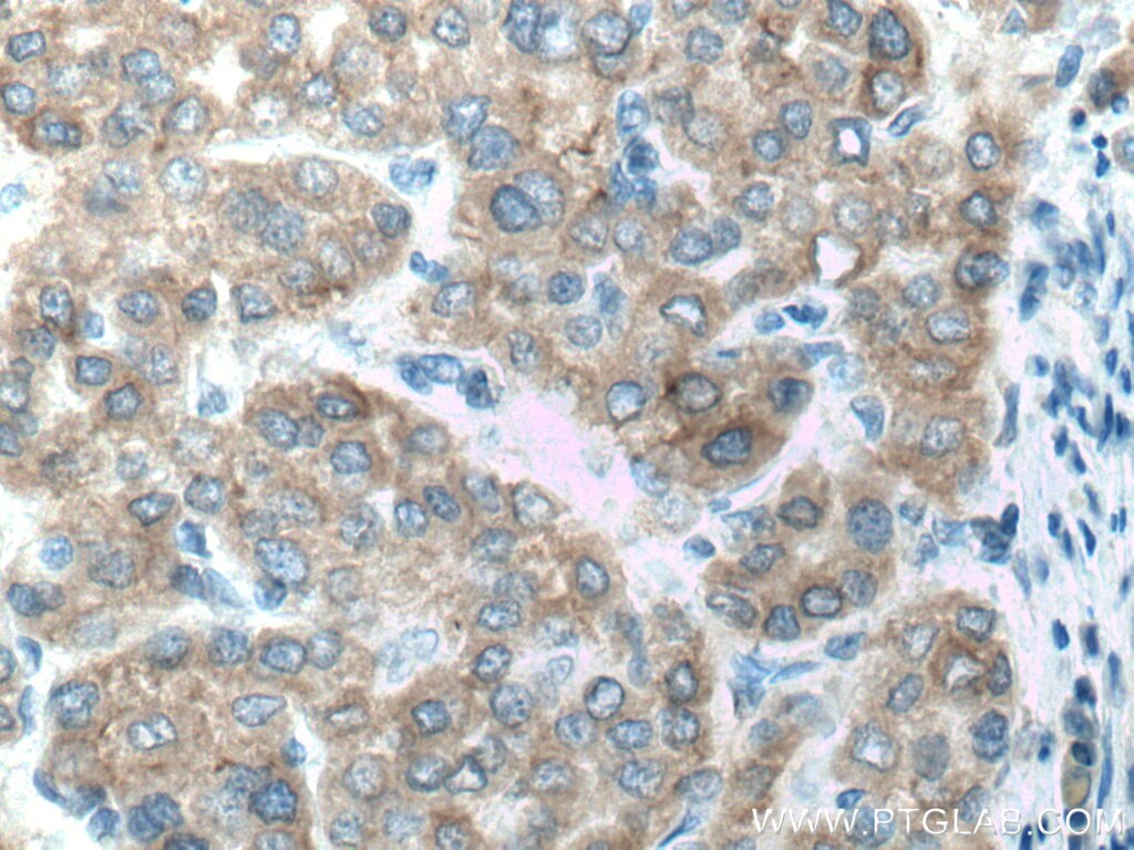 Immunohistochemistry (IHC) staining of human liver cancer tissue using CYP2D6/7 Polyclonal antibody (17868-1-AP)