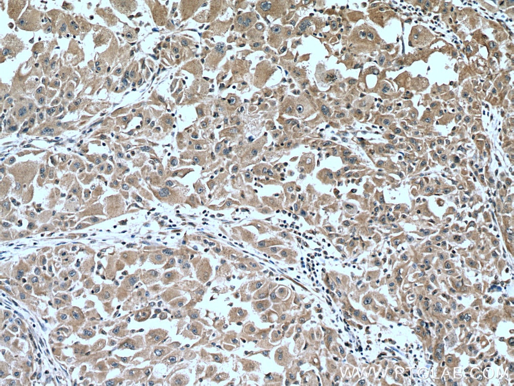 Immunohistochemistry (IHC) staining of human liver cancer tissue using CYP2D6 Monoclonal antibody (60297-1-Ig)