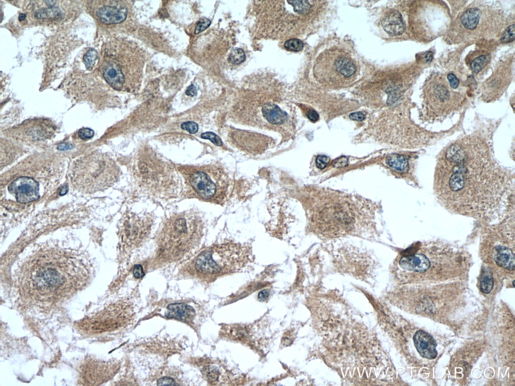 Immunohistochemistry (IHC) staining of human liver cancer tissue using CYP2D6 Monoclonal antibody (60297-1-Ig)