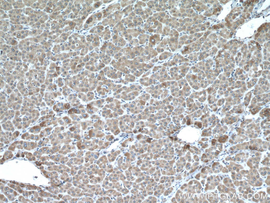 Immunohistochemistry (IHC) staining of human liver cancer tissue using CYP2E1-Specific Polyclonal antibody (19937-1-AP)