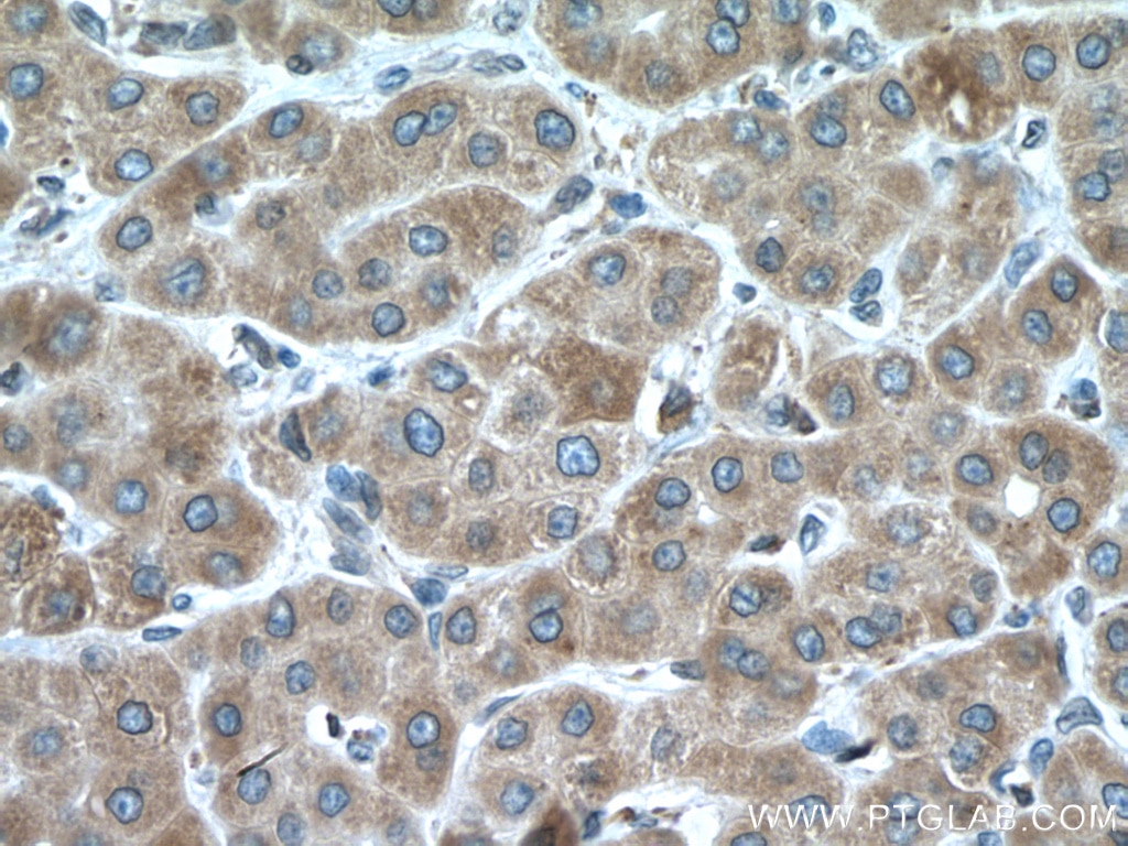 Immunohistochemistry (IHC) staining of human liver cancer tissue using CYP2E1-Specific Polyclonal antibody (19937-1-AP)