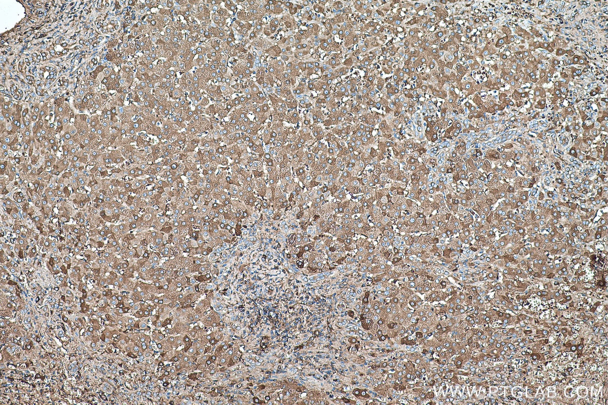 IHC staining of human liver cancer using 67263-1-Ig