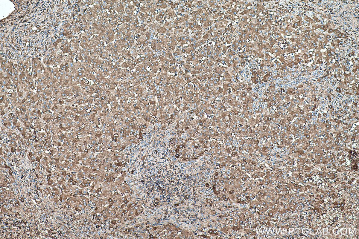 Immunohistochemistry (IHC) staining of human liver cancer tissue using CYP2E1-Specific Monoclonal antibody (67263-1-Ig)