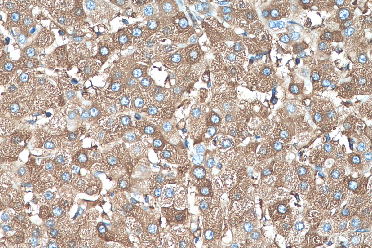 Immunohistochemistry (IHC) staining of human liver cancer tissue using CYP2E1-Specific Monoclonal antibody (67263-1-Ig)