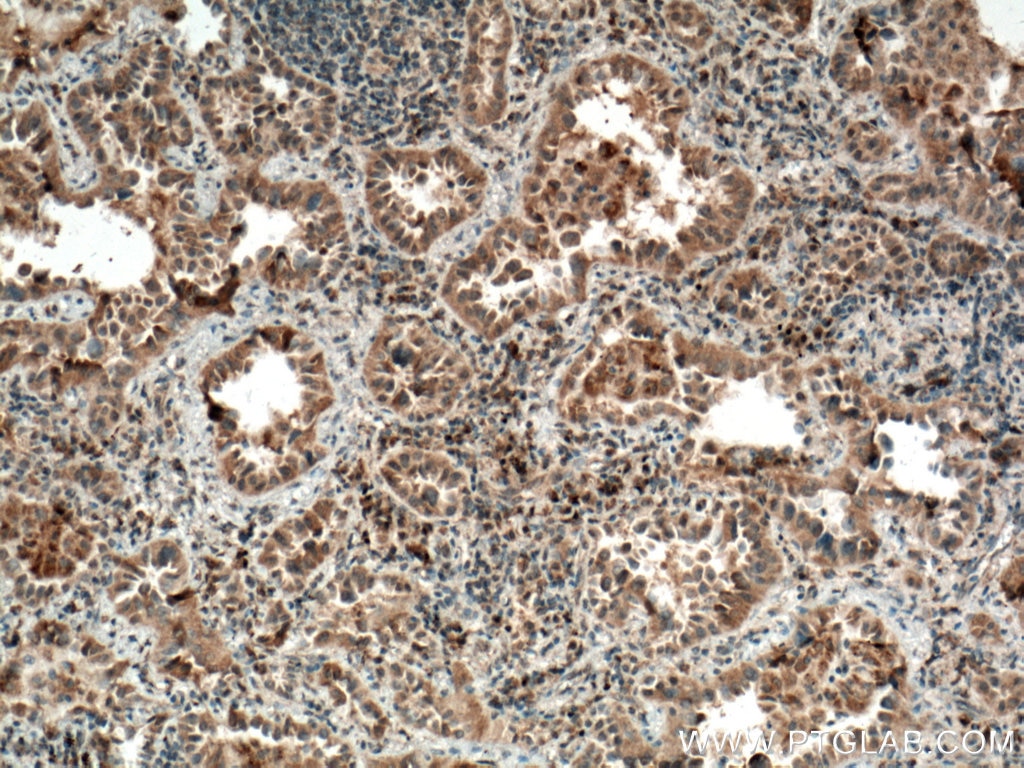 Immunohistochemistry (IHC) staining of human lung cancer tissue using CYP2F1 Polyclonal antibody (21579-1-AP)