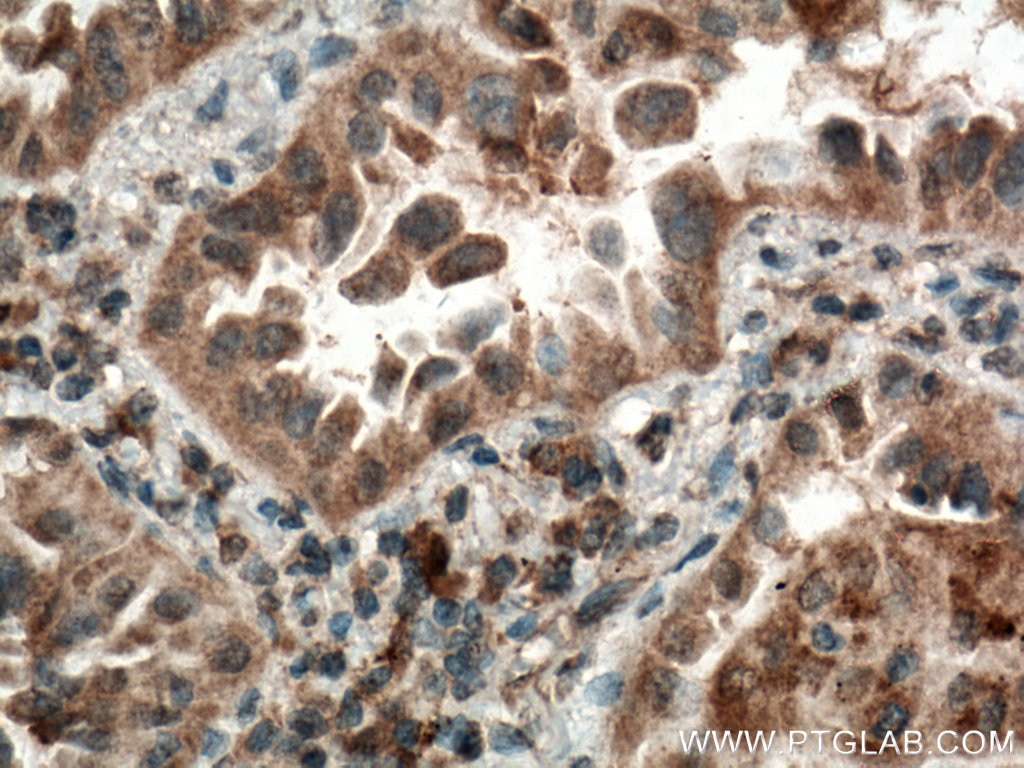 Immunohistochemistry (IHC) staining of human lung cancer tissue using CYP2F1 Polyclonal antibody (21579-1-AP)