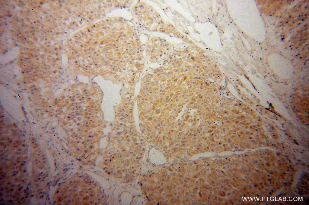 Immunohistochemistry (IHC) staining of human liver cancer tissue using CYP2J2 Polyclonal antibody (13562-1-AP)