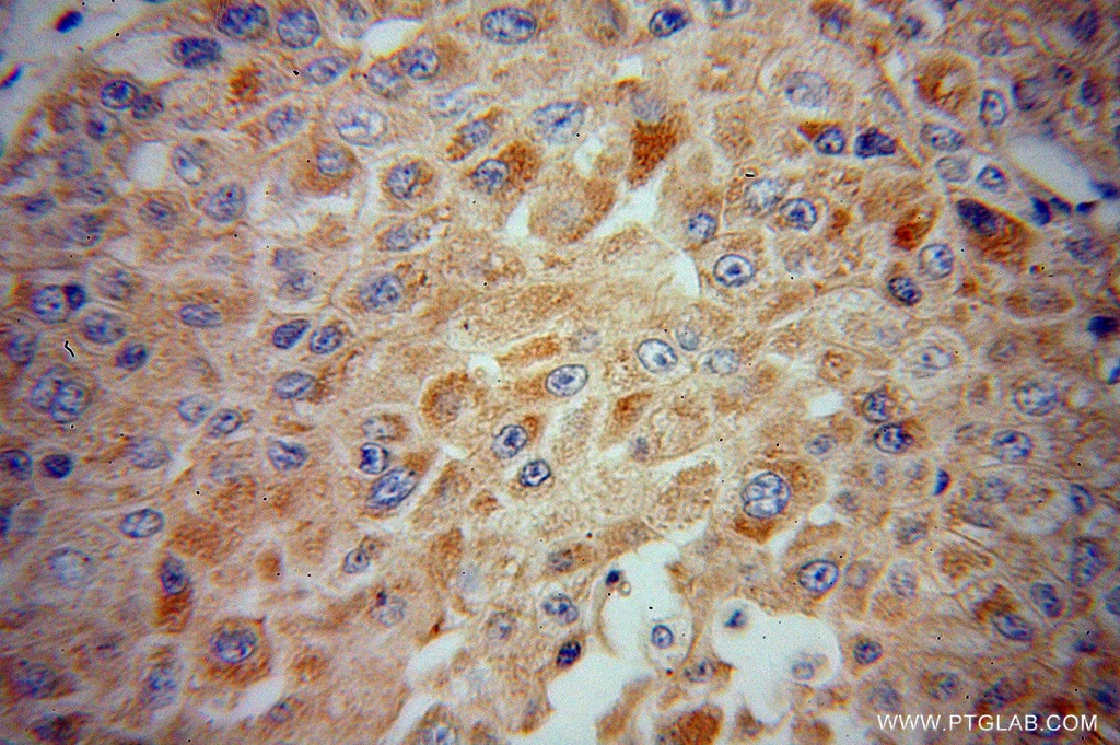 Immunohistochemistry (IHC) staining of human liver cancer tissue using CYP2J2 Polyclonal antibody (13562-1-AP)