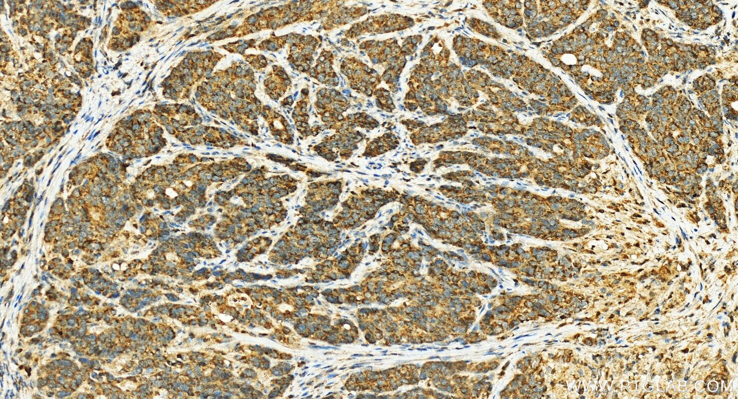 Immunohistochemistry (IHC) staining of human stomach cancer tissue using CYP2W1 Polyclonal antibody (12904-1-AP)