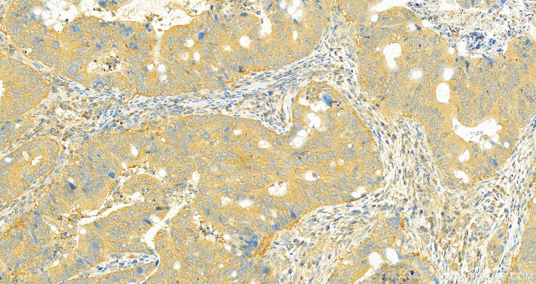 Immunohistochemistry (IHC) staining of human colon cancer tissue using CYP2W1 Monoclonal antibody (67419-1-Ig)