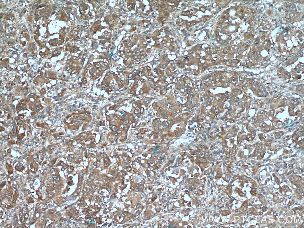 Immunohistochemistry (IHC) staining of human liver cancer tissue using CYP39A1 Polyclonal antibody (16062-1-AP)