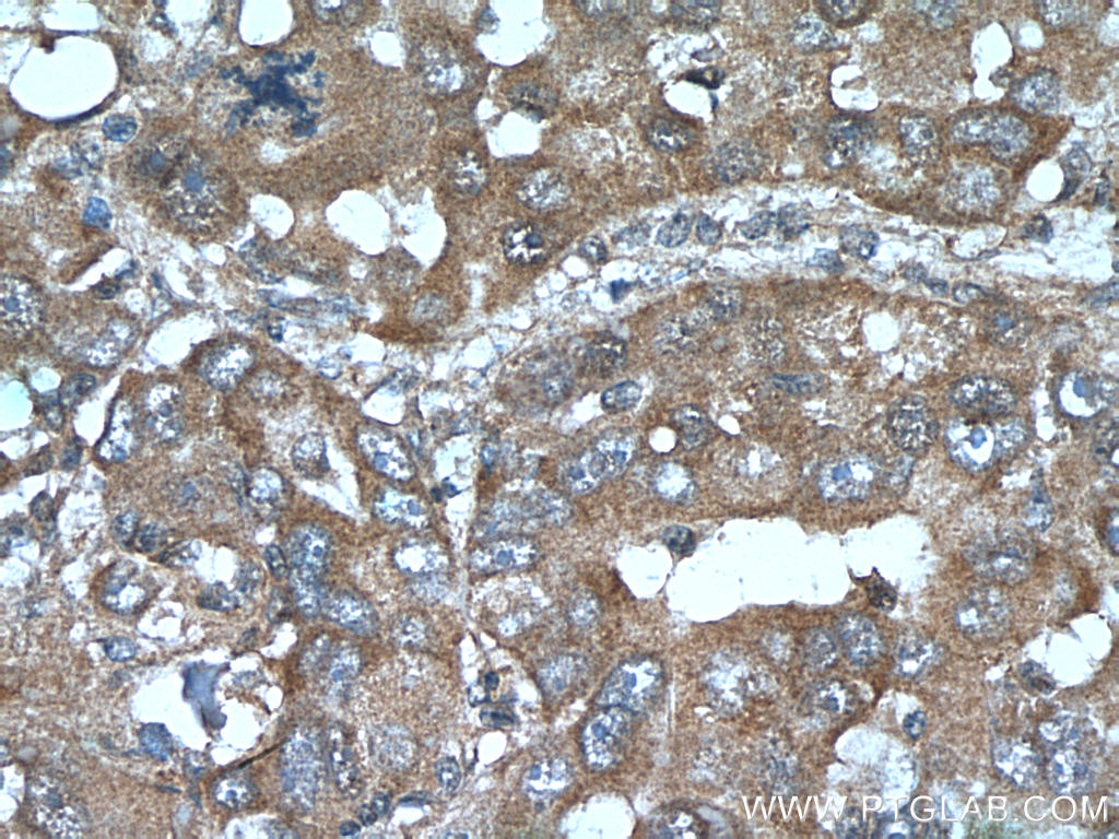 Immunohistochemistry (IHC) staining of human liver cancer tissue using CYP39A1 Polyclonal antibody (16062-1-AP)