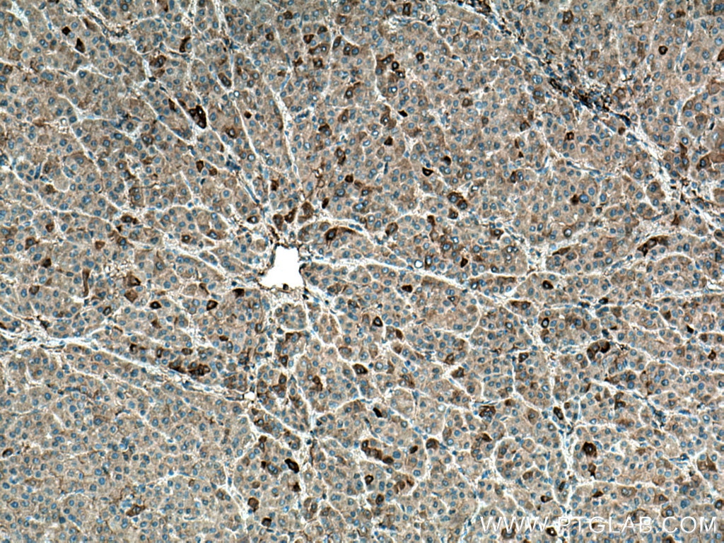 Immunohistochemistry (IHC) staining of human liver cancer tissue using CYP3A4 Monoclonal antibody (67110-1-Ig)