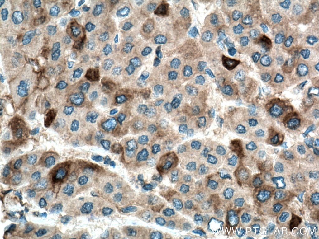 Immunohistochemistry (IHC) staining of human liver cancer tissue using CYP3A4 Monoclonal antibody (67110-1-Ig)