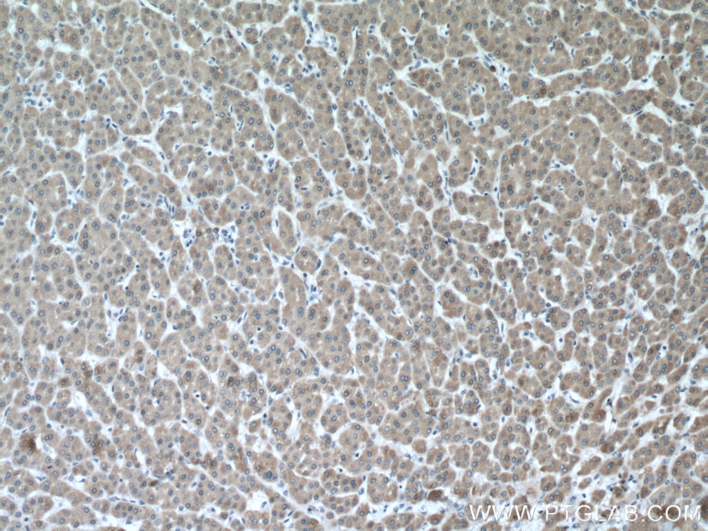 Immunohistochemistry (IHC) staining of human liver cancer tissue using CYP3A5 Polyclonal antibody (13737-1-AP)