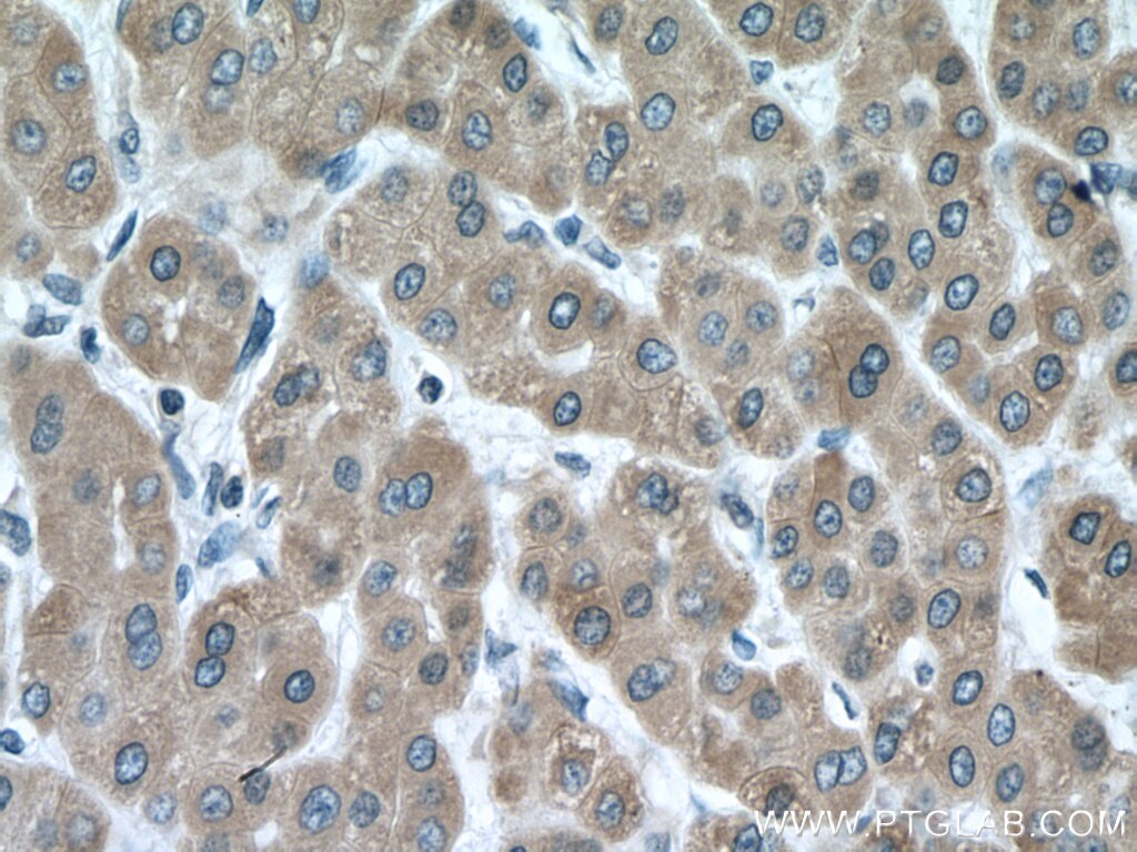 Immunohistochemistry (IHC) staining of human liver cancer tissue using CYP3A5 Polyclonal antibody (13737-1-AP)