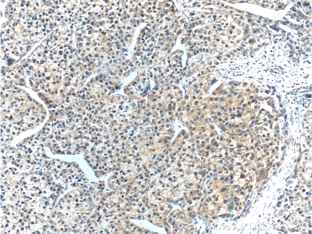 Immunohistochemistry (IHC) staining of human liver cancer tissue using CYP3A7 Polyclonal antibody (55428-1-AP)