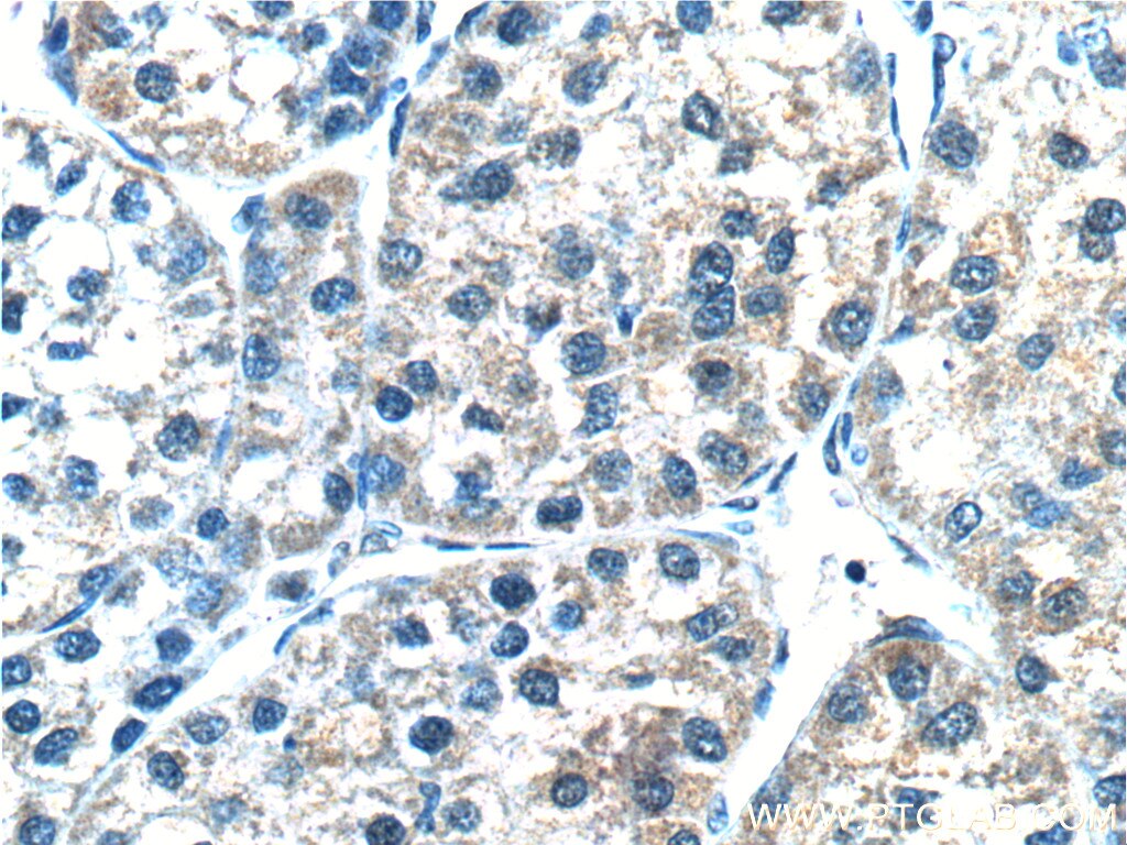 Immunohistochemistry (IHC) staining of human liver cancer tissue using CYP3A7 Polyclonal antibody (55428-1-AP)