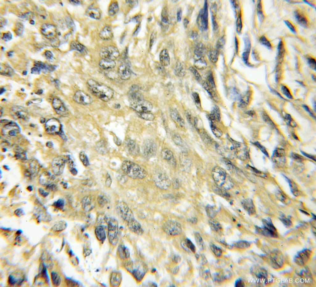 Immunohistochemistry (IHC) staining of human lung cancer tissue using CYP4B1 Polyclonal antibody (11771-1-AP)