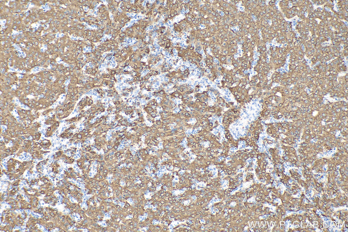 Immunohistochemistry (IHC) staining of human liver cancer tissue using CYP4F11 Polyclonal antibody (12286-1-AP)