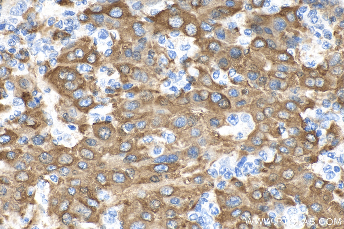 Immunohistochemistry (IHC) staining of human liver cancer tissue using CYP4F11 Polyclonal antibody (12286-1-AP)