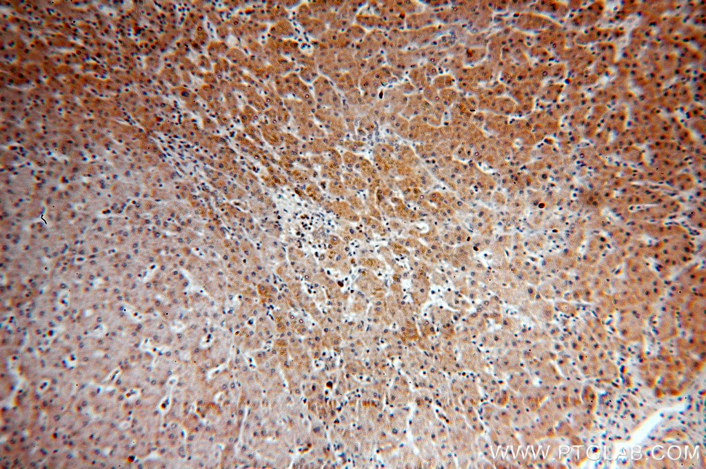 Immunohistochemistry (IHC) staining of human hepatocirrhosis tissue using CYP4F11-Specific Polyclonal antibody (20012-1-AP)