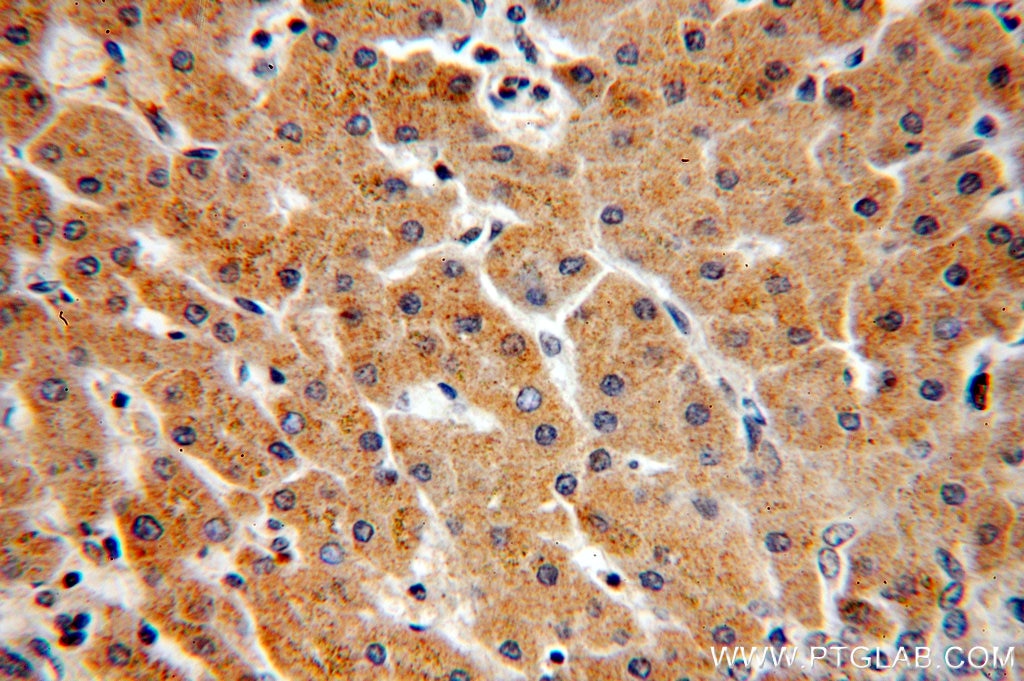 Immunohistochemistry (IHC) staining of human hepatocirrhosis tissue using CYP4F11-Specific Polyclonal antibody (20012-1-AP)