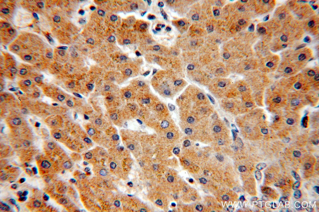 IHC staining of human hepatocirrhosis using 20012-1-AP