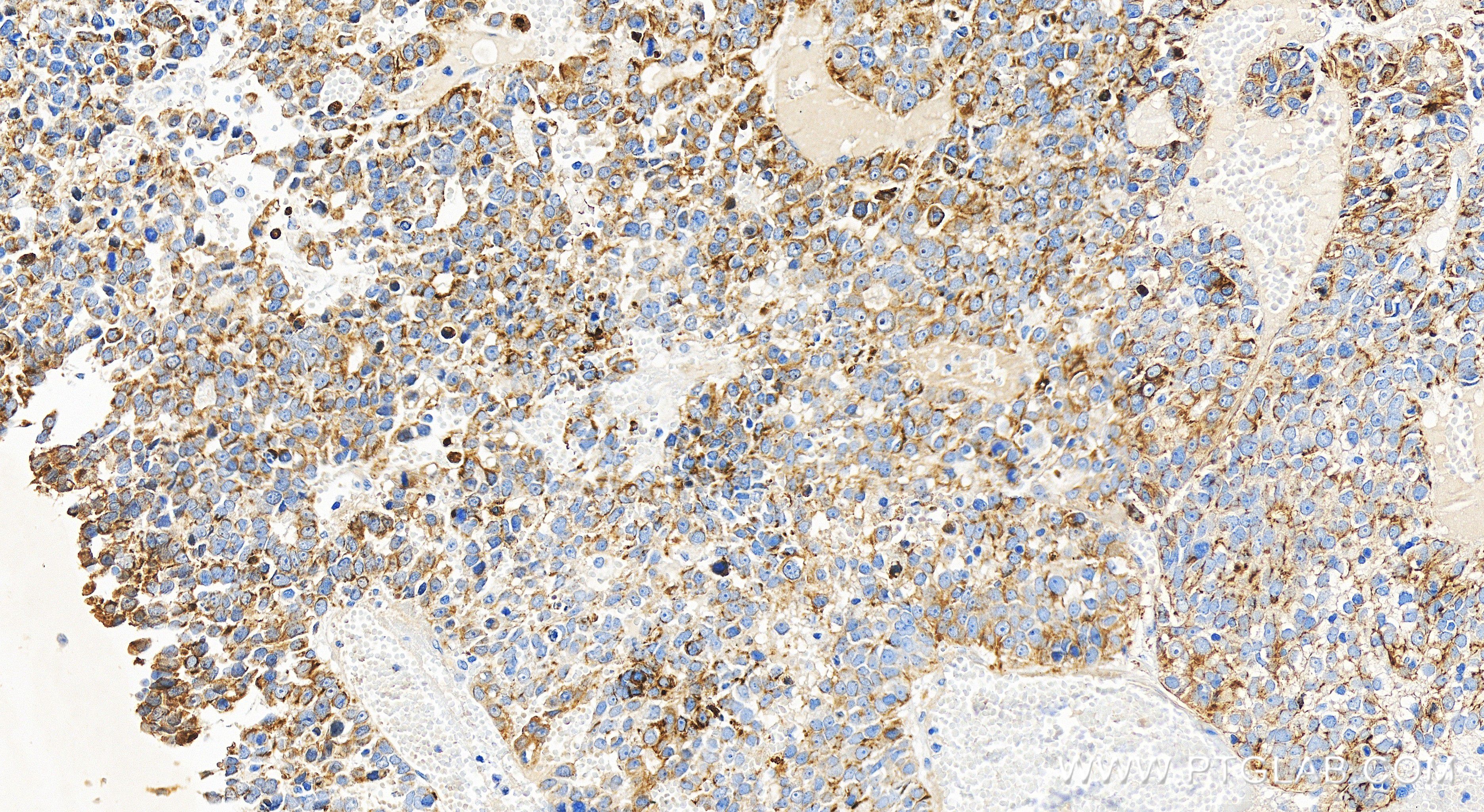 Immunohistochemistry (IHC) staining of human liver cancer tissue using CYP4F2-Specific Recombinant antibody (85320-1-RR)