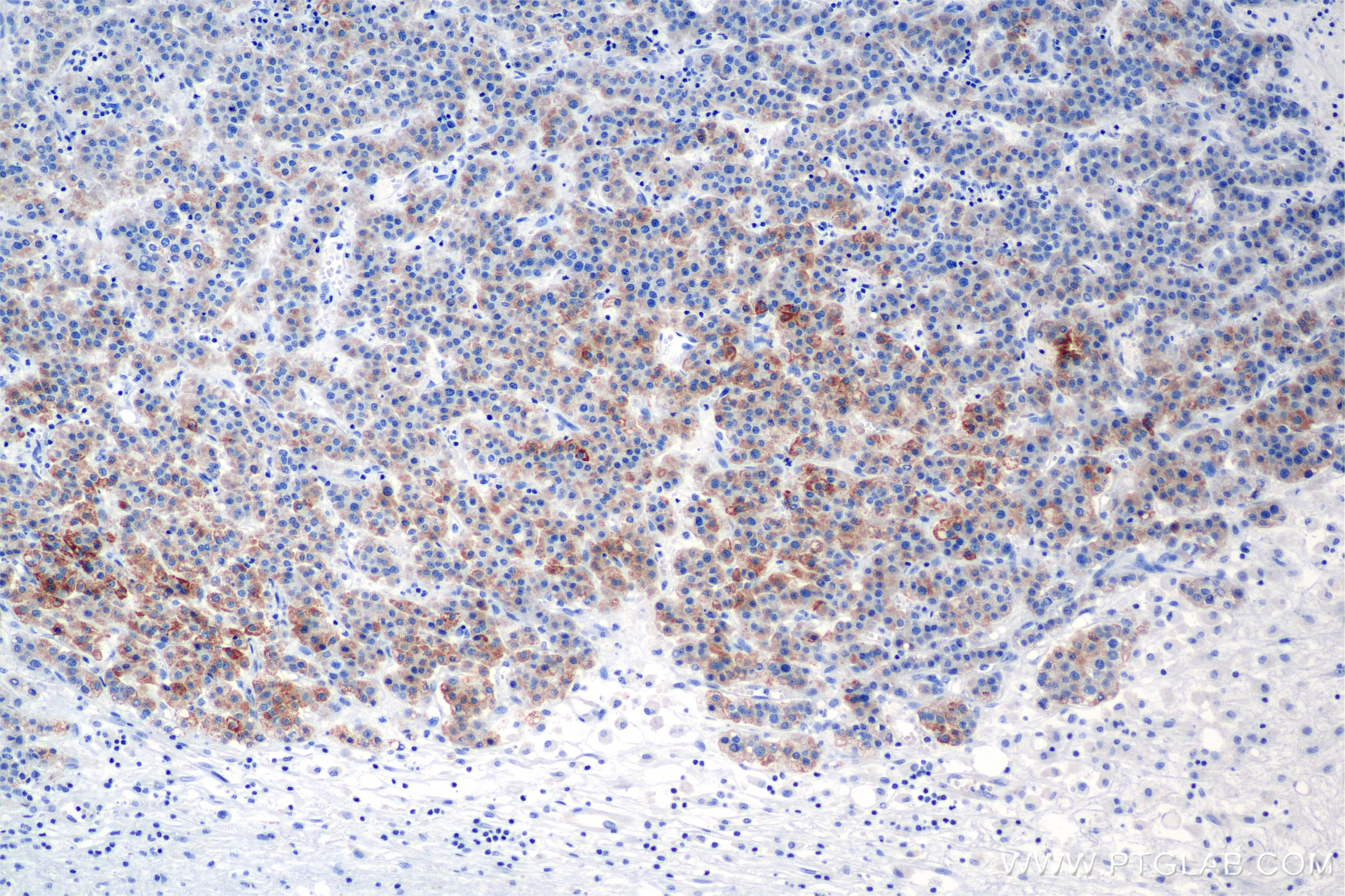 Immunohistochemistry (IHC) staining of Human Hepatocellular Cancer using CYP4F2-Specific Recombinant antibody (85320-1-RR)