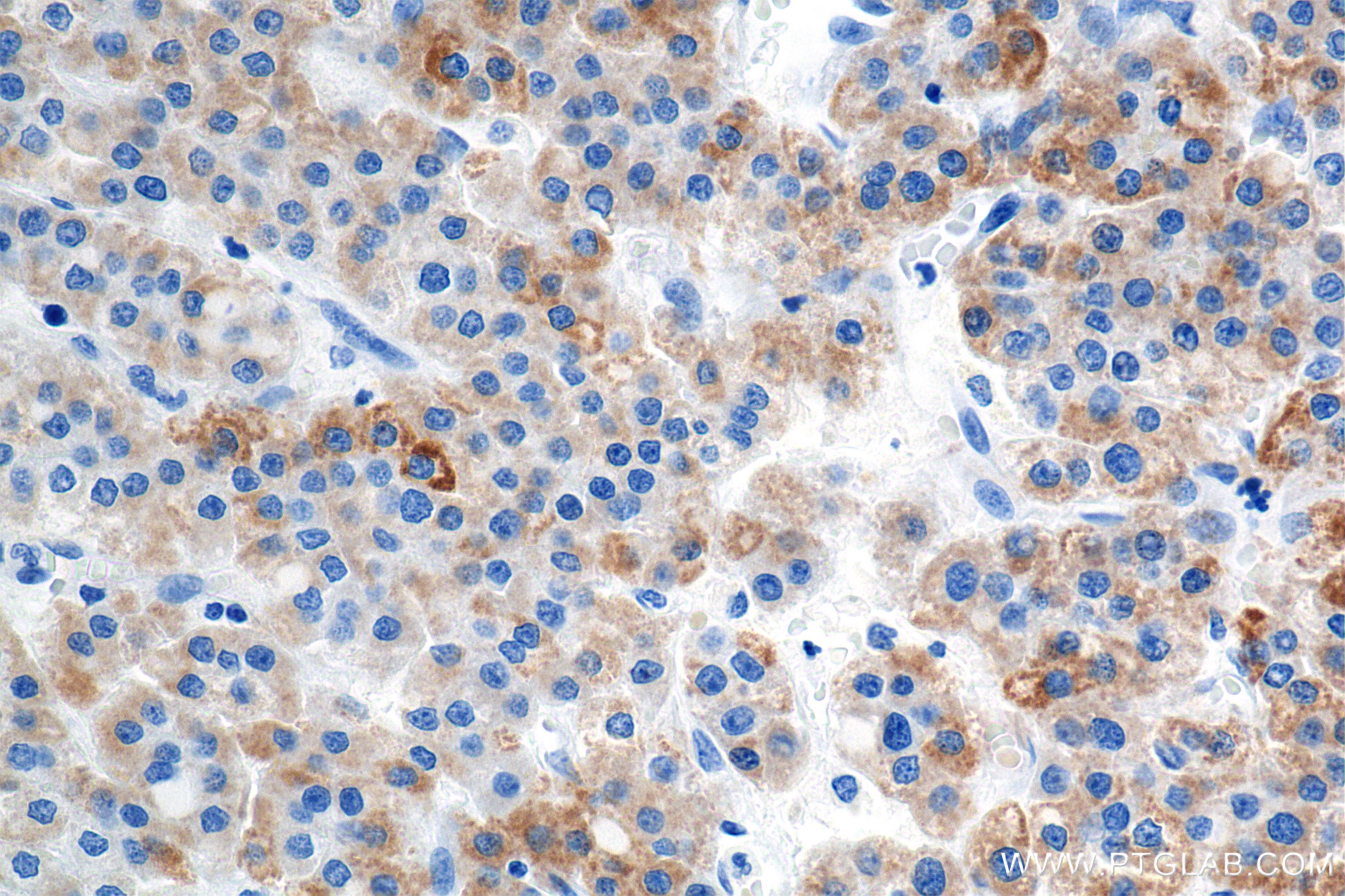 Immunohistochemistry (IHC) staining of Human Hepatocellular Cancer using CYP4F2-Specific Recombinant antibody (85320-1-RR)