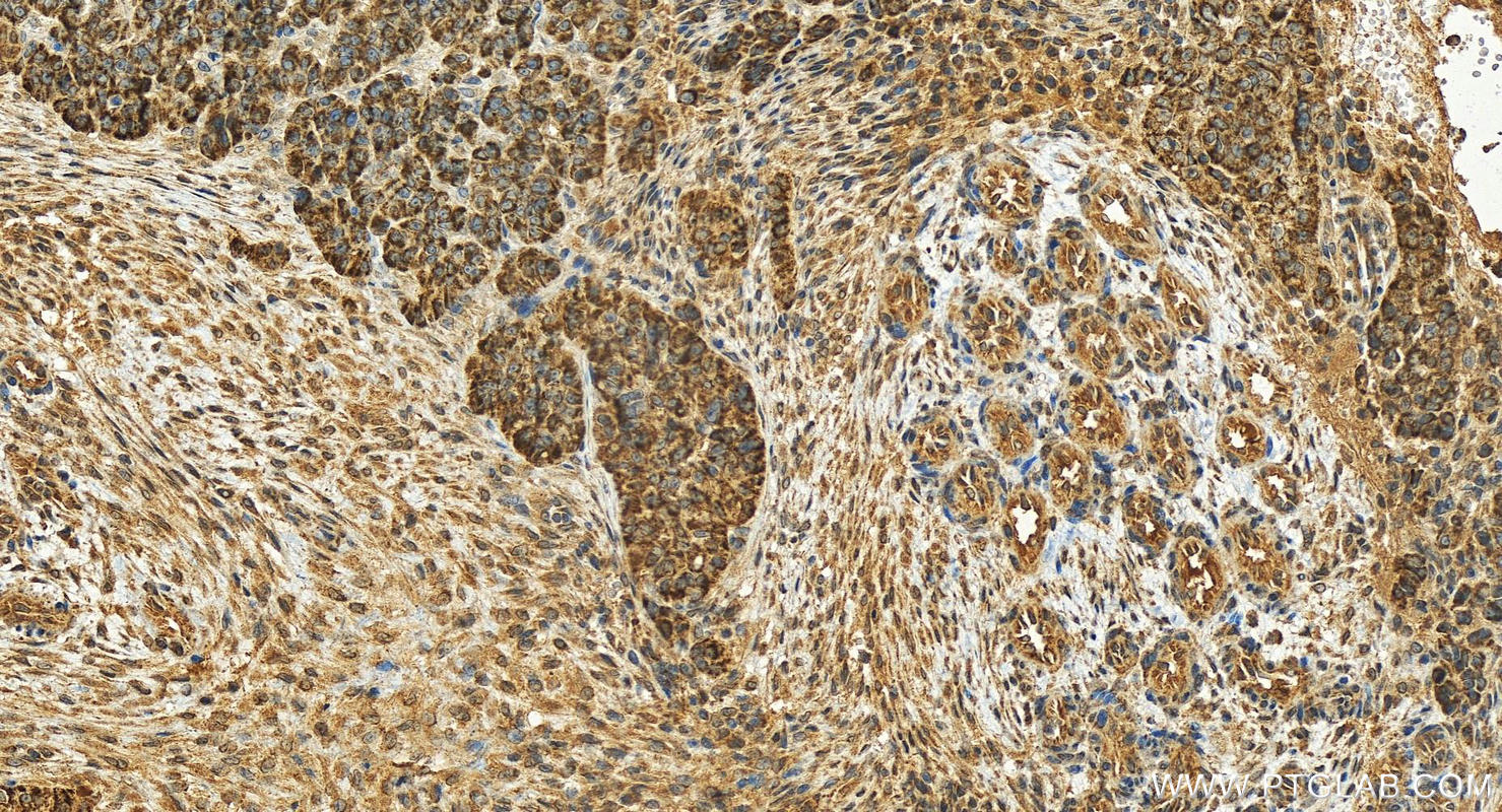 Immunohistochemical analysis of paraffin-embedded human ovarian cancer slide using 19701-1-AP (CYP4F3 antibody) at dilution of 1:100 (under 20x lens). Heat mediated antigen retrieval with Tris-EDTA buffer (pH 9.0). Immunohistochemistry (IHC) staining of human ovarian cancer using CYP4F3 Polyclonal antibody (19701-1-AP)