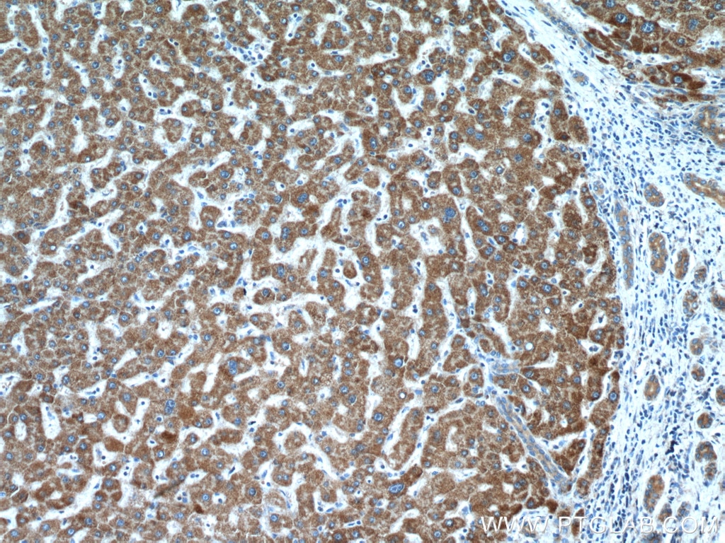 Immunohistochemistry (IHC) staining of human liver cancer tissue using CYP7B1 Polyclonal antibody (24889-1-AP)