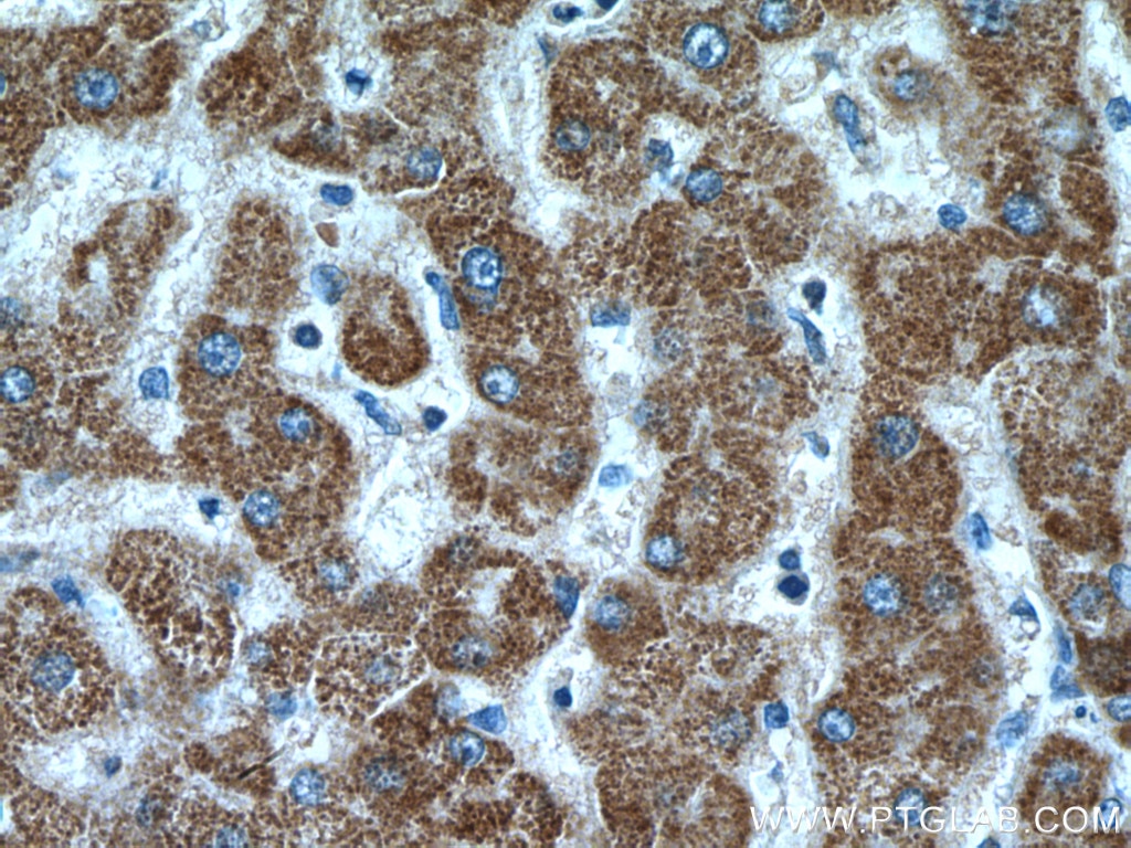 Immunohistochemistry (IHC) staining of human liver cancer tissue using CYP7B1 Polyclonal antibody (24889-1-AP)