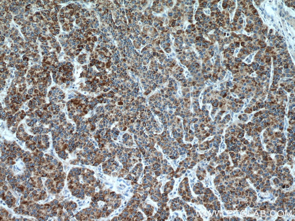 Immunohistochemistry (IHC) staining of human liver cancer tissue using CYP7B1 Polyclonal antibody (24889-1-AP)