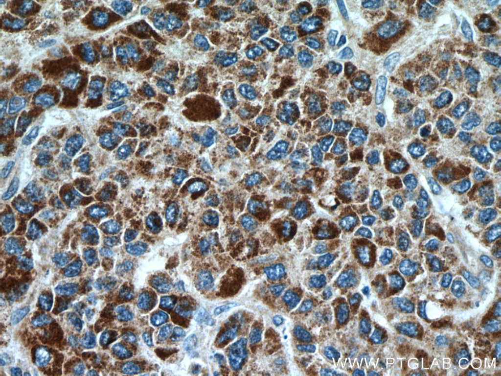 Immunohistochemistry (IHC) staining of human liver cancer tissue using CYP7B1 Polyclonal antibody (24889-1-AP)